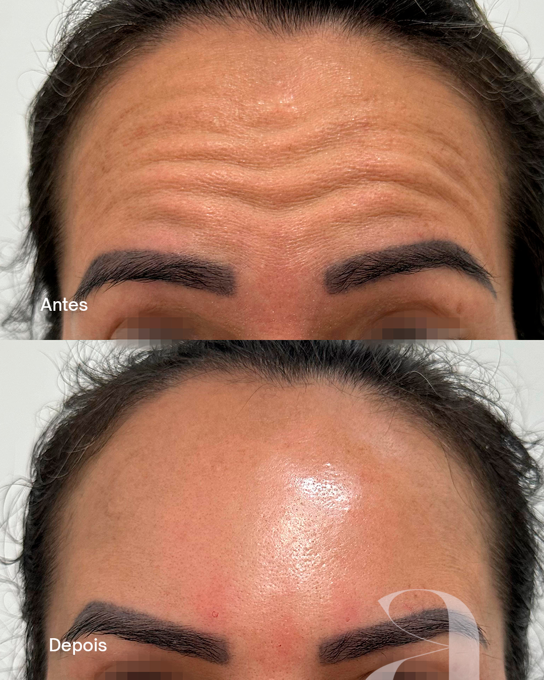 Antes e Depois - Botox 2