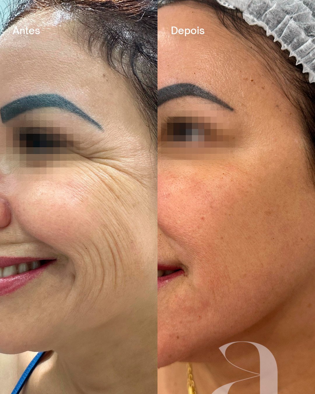 Antes e Depois - Botox 4