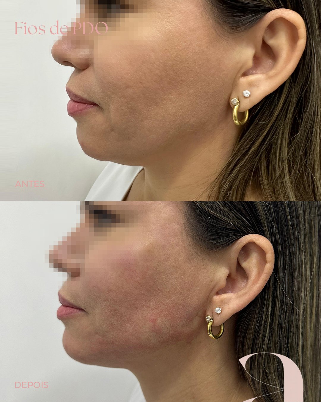 Antes e Depois - Estética A