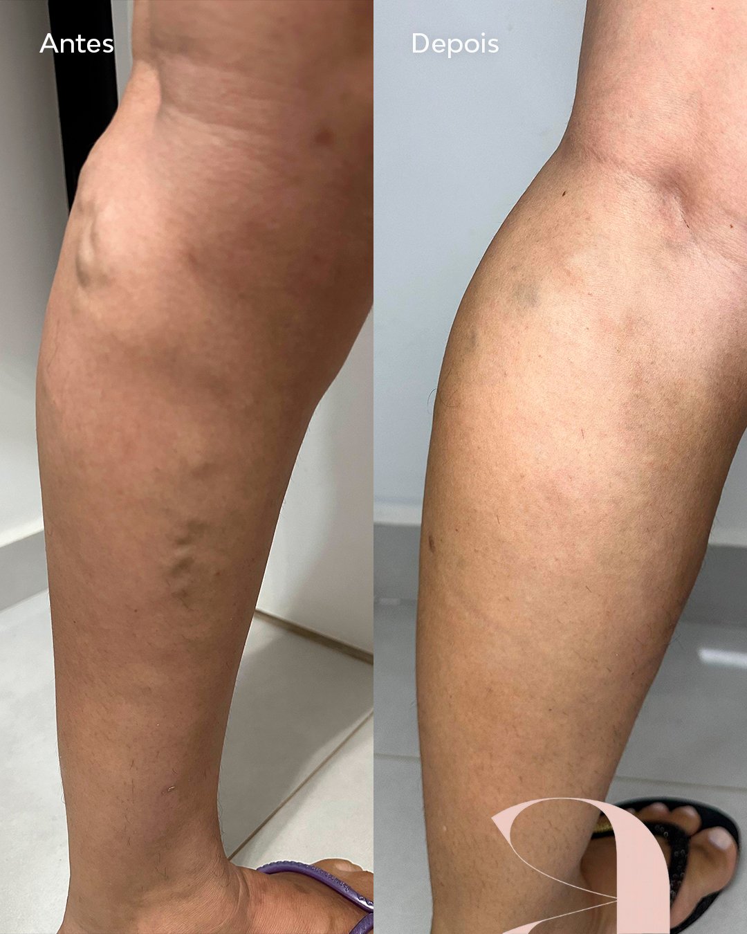 Antes e Depois Varizes - 1